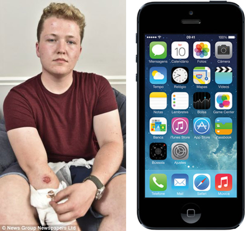 Jovem afirma ter sido queimado por iPhone 5 enquanto dormia