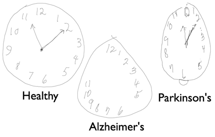Caneta Digital pode ajudar a diagnosticar Alzheimer