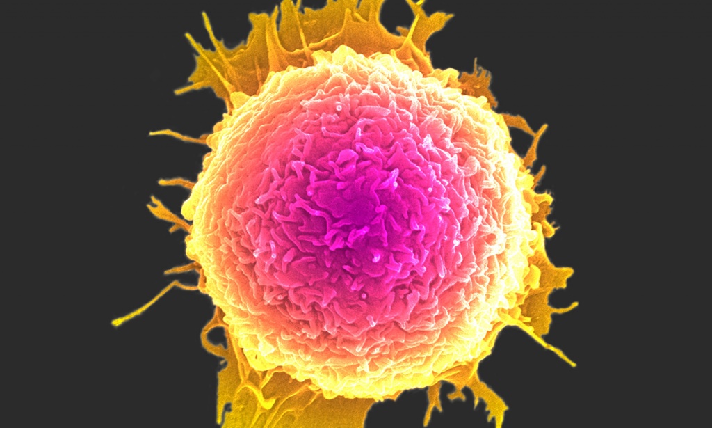 Assinatura nanométrica pode revolucionar o diagnóstico do cancro