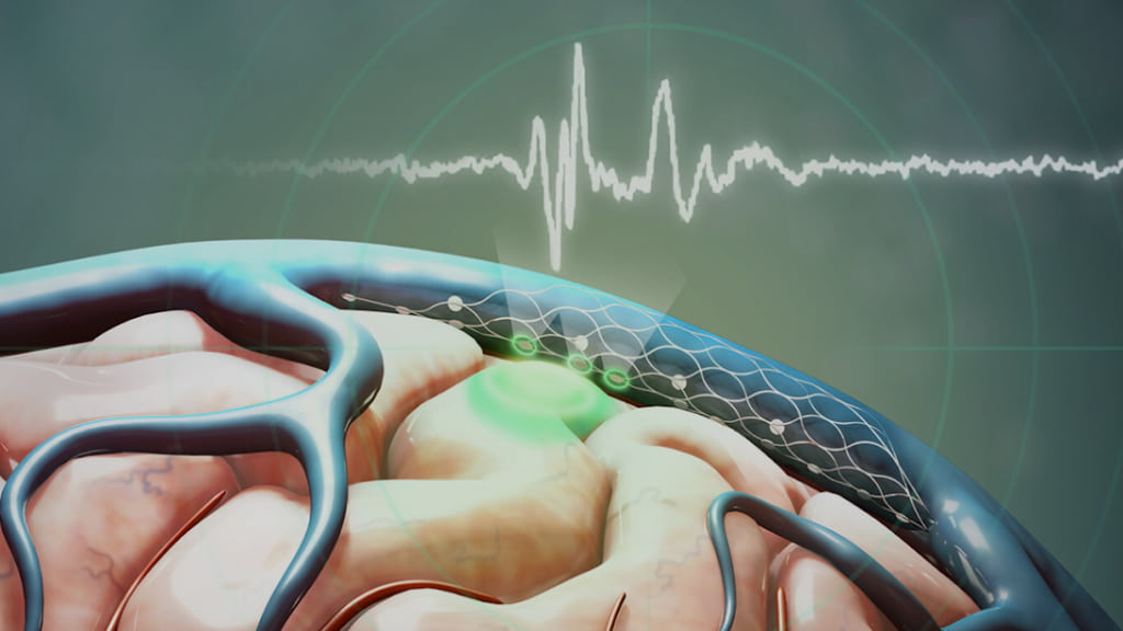 Synchron recebe aprovação para testar implante cerebral em humanos