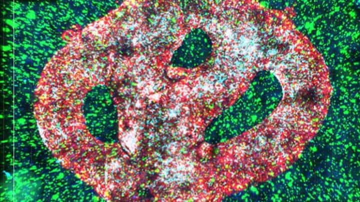 Tumor cerebral maligno impresso em 3D pela primeira vez