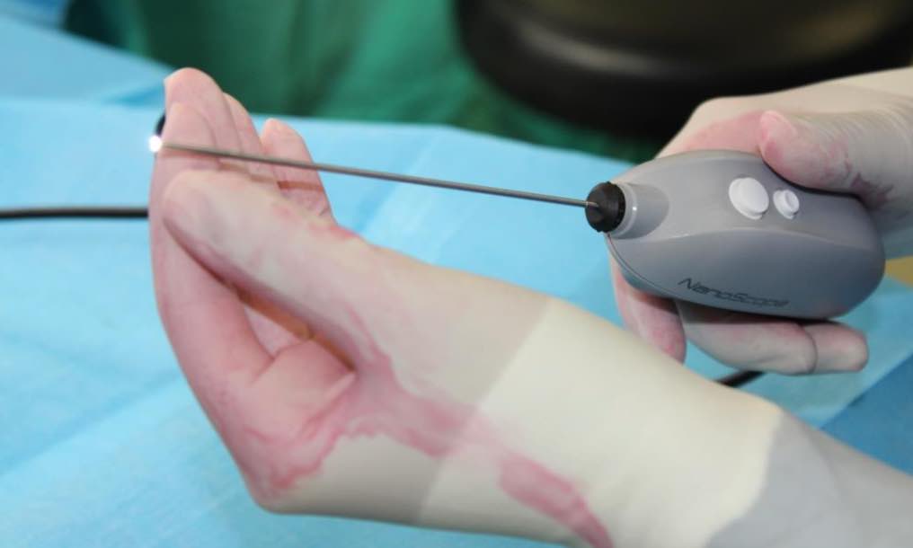 CHUCB: primeira cirurgia pouco invasiva do punho usando NanoScope