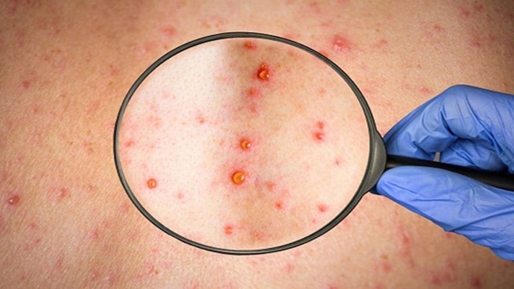 Monkeypox: Primeiro caso numa mulher detetado em Espanha
