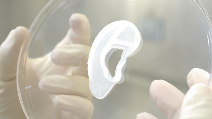 Primeira orelha impressa em 3D transplantada com sucesso