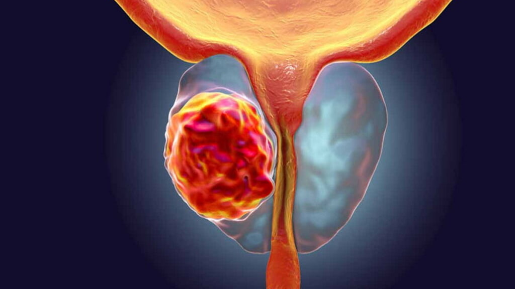Operação inovadora pode curar o cancro da próstata em apenas uma hora