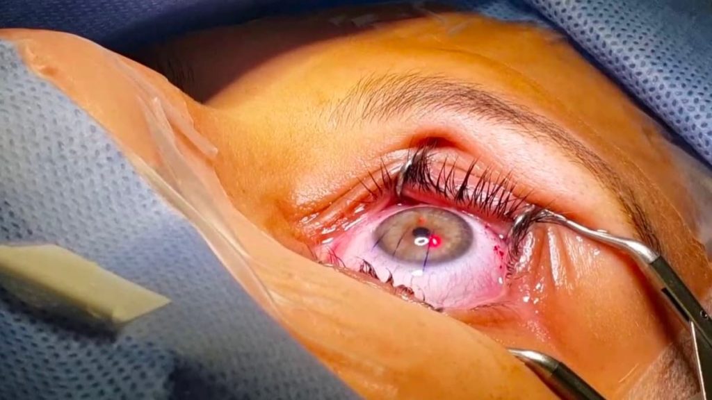 Sabia que os espelhos do James Webb influenciaram a precisão da cirurgia ocular?