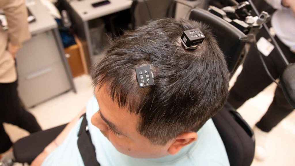 Thomas recuperou a sensibilidade e o movimento graças a implantes cerebrais e IA