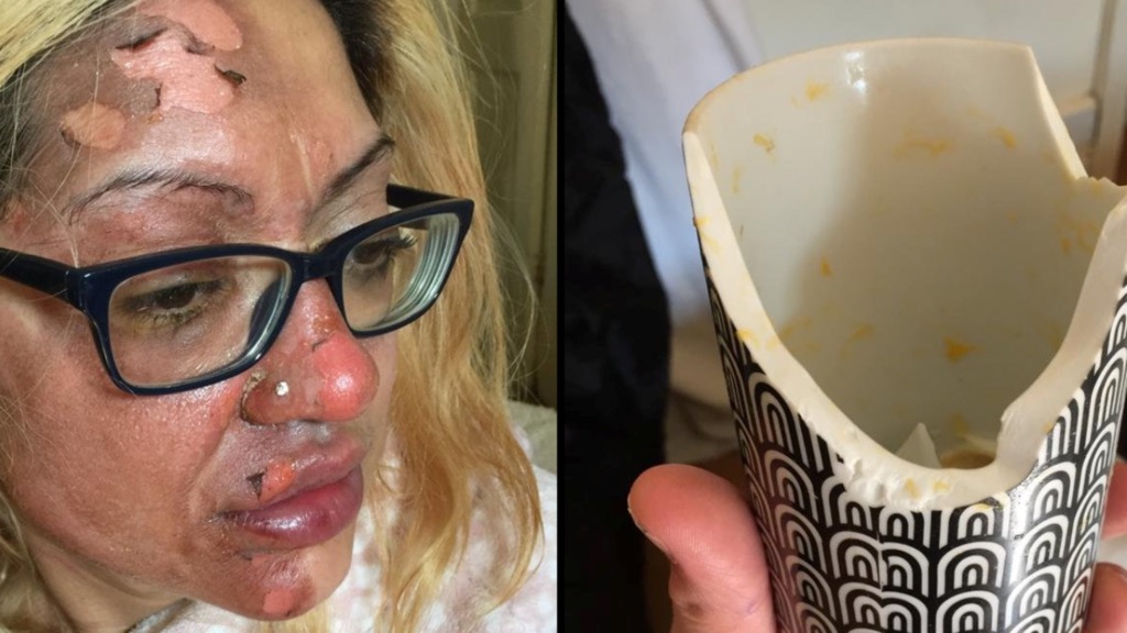 Mulher queima cara ao cozer ovo no microondas para o TikTok