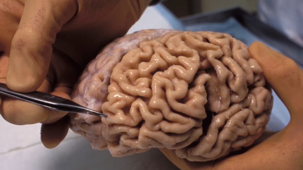 Novo estudo deteta microplásticos em tecido cerebral humano