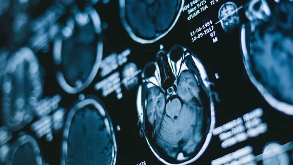 Nova análise ao sangue deteta o glioblastoma, cancro cerebral mortal, numa hora