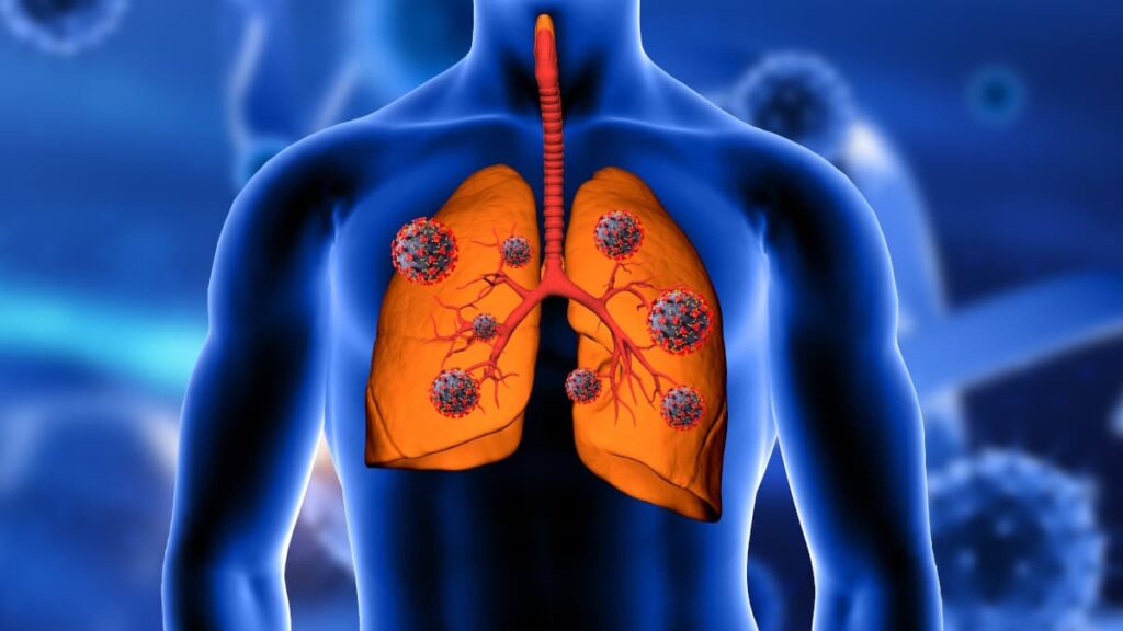 Cancro do pulmão está a aumentar nos não fumadores e há uma potencial razão