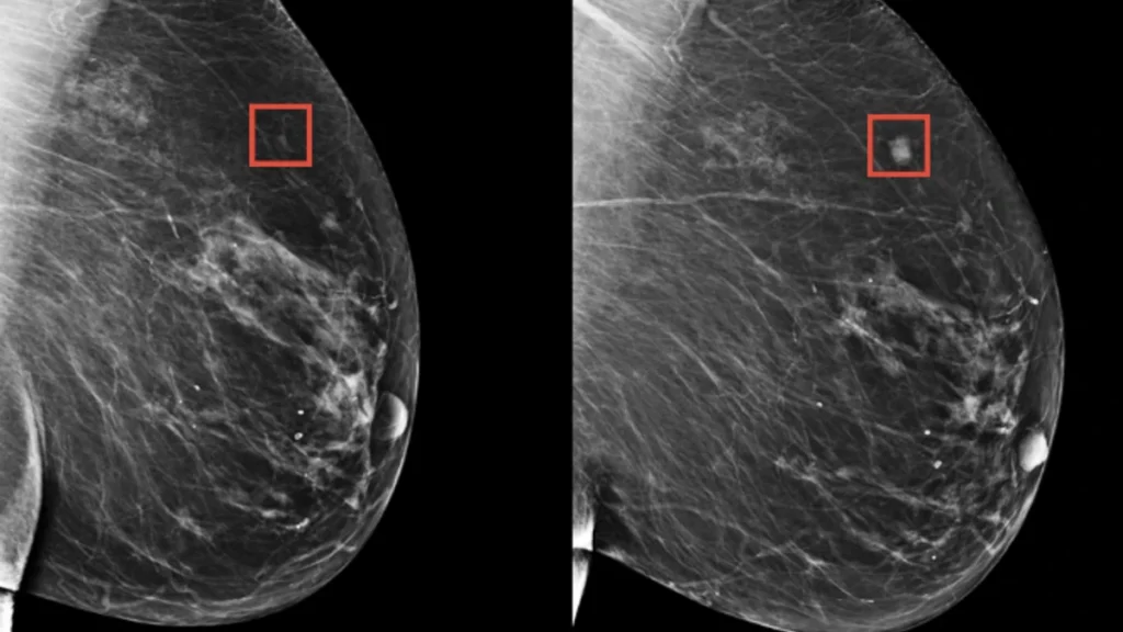 Novo teste utiliza IA para detetar cancro da mama no estágio mais precoce